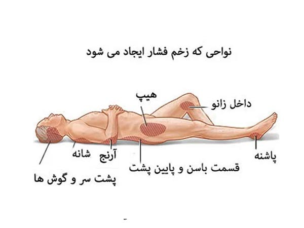 نحوه خوابیدن تشک زخم بستر